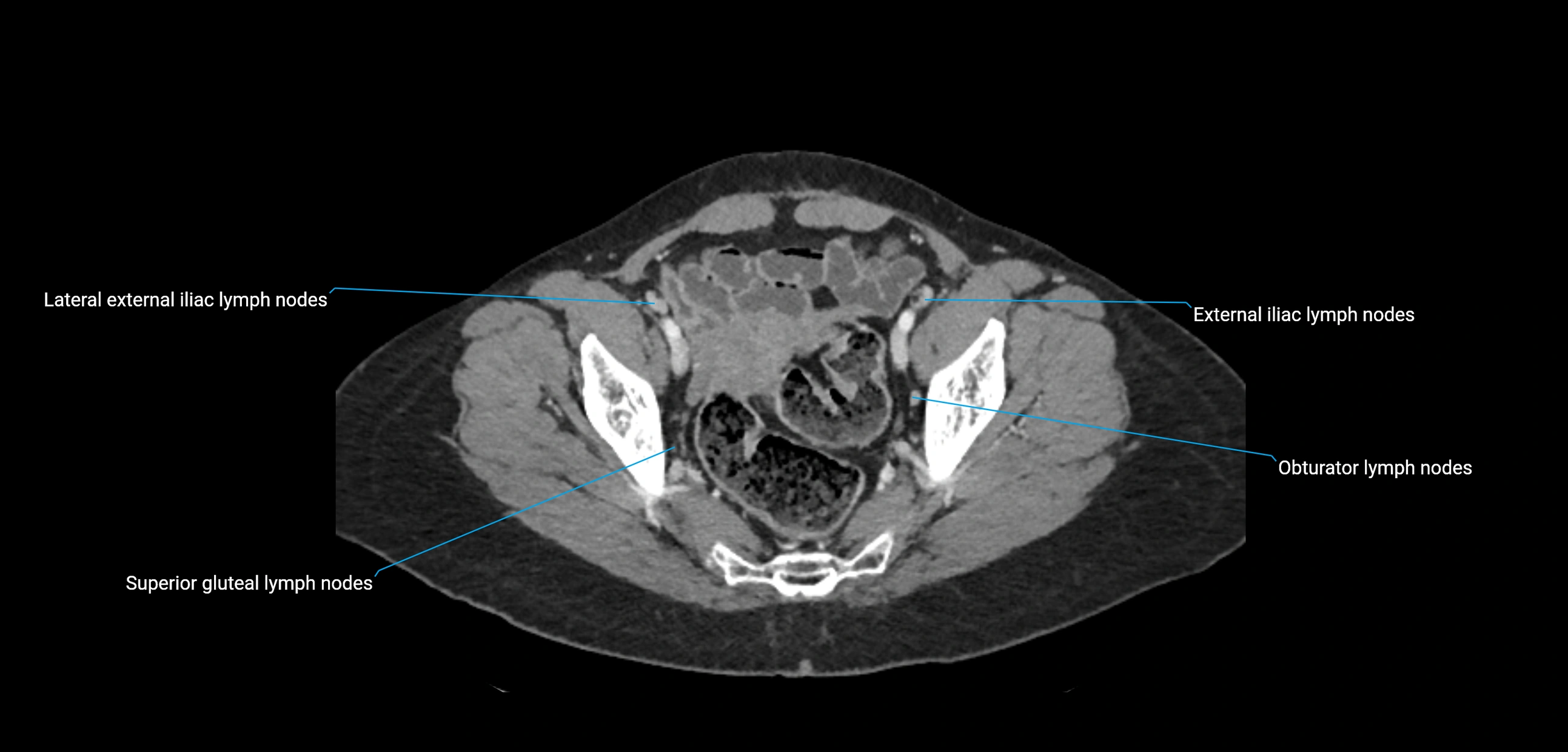 CT ct abdominal lymph nodes  axial cross sectional anatomy  enchanced radiology image -img-00002-00360.webp